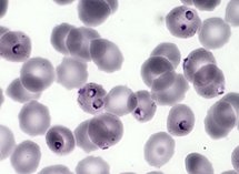 Le paludisme (Plasmodium falciparum, Protozoaires) : hématies polyparasitées par Plasmodium falciparum. Microscopie optique, coloration au MGG (May Gründval Giemsa).