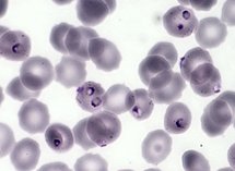 Le paludisme (Plasmodium falciparum, Protozoaires) : hématies polyparasitées par Plasmodium falciparum. Microscopie optique, coloration au MGG (May Gründval Giemsa). Le paludisme (Plasmodium falciparum, Protozoaires) : hématies polyparasitées par Plasmodium falciparum. Microscopie optique, coloration au MGG (May Gründval Giemsa).