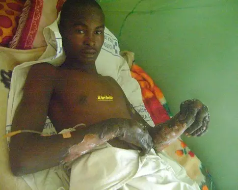 Un jeune incendié : Les barbares Bogobogo sèment la terreur