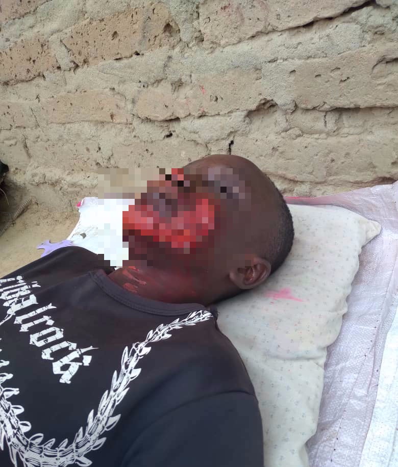Tchad : il brûle le visage de son ami qui l'a dénoncé pour vol Tchad : il brûle le visage de son ami qui l'a dénoncé pour vol