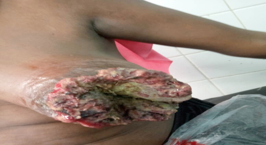 Cancer du sein et du col de l’utérus : un sujet tabou dans le milieu tchadien Cancer du sein et du col de l’utérus : un sujet tabou dans le milieu tchadien