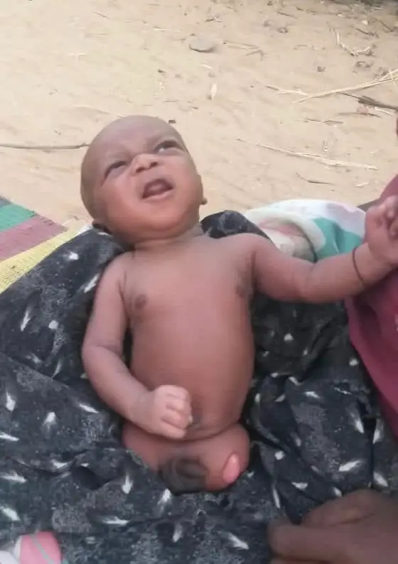 Tchad : victime d'une malformation congénitale, un bébé est né sans pieds au Sila
