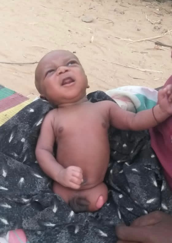Tchad : victime d'une malformation congénitale, un bébé est né sans pieds au Sila Tchad : victime d'une malformation congénitale, un bébé est né sans pieds au Sila