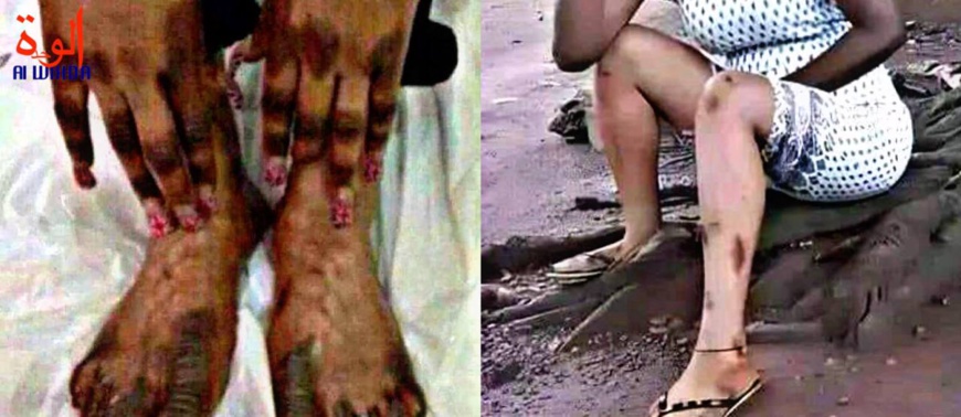 Dépigmentation au Tchad : elles veulent absolument devenir blanches Dépigmentation au Tchad : elles veulent absolument devenir blanches