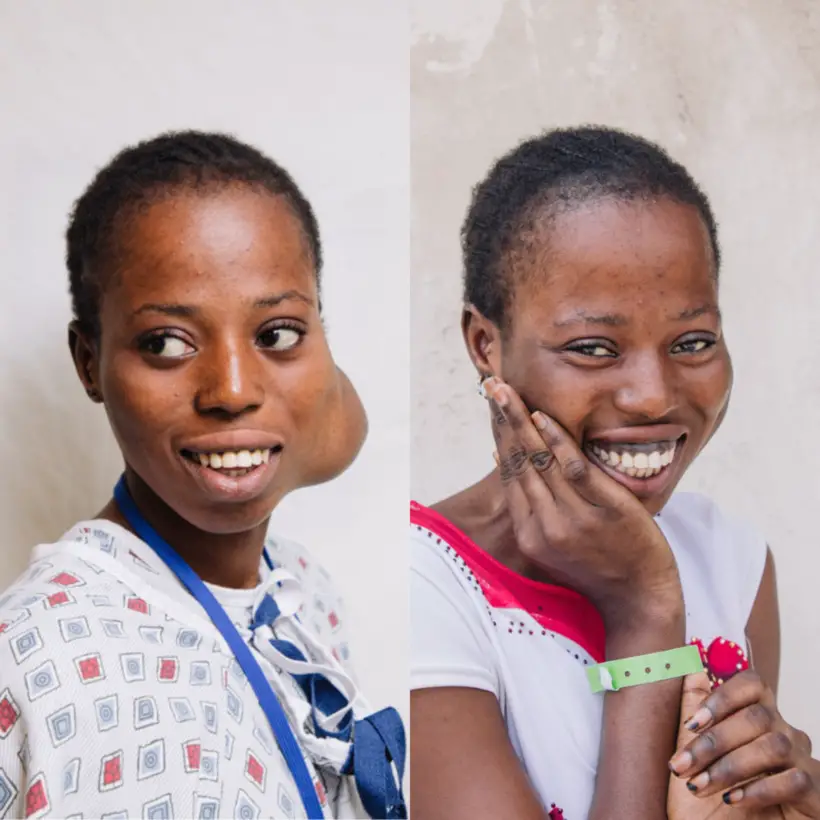 Sénégal : une adolescente dont la tumeur avait été qualifiée "d’inopérable" voit sa vie transformée