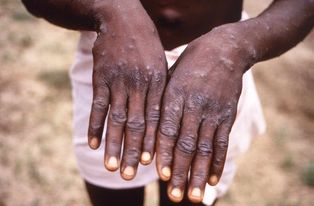 RDC : avec l’apparition de l’épidémie mortelle de Mpox, les enfants sont en danger
