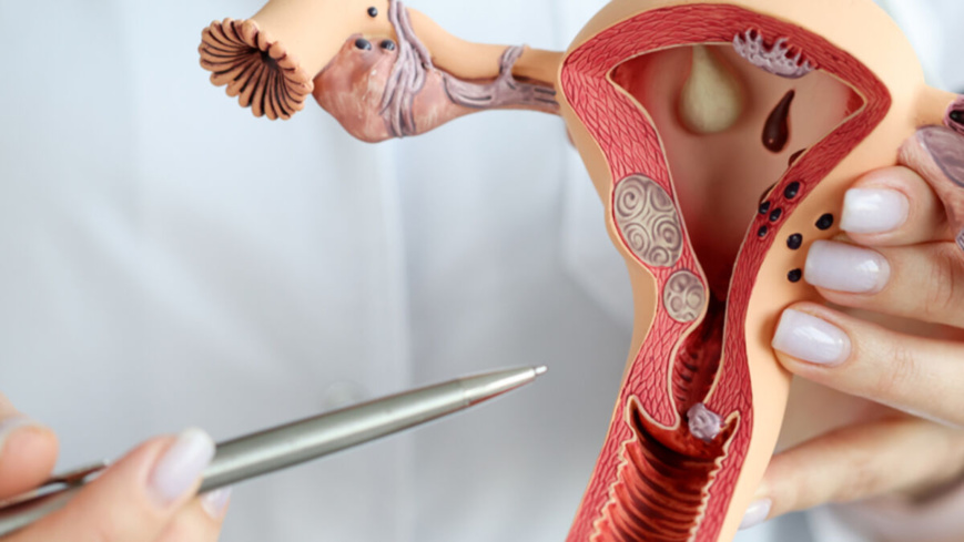 Tchad : le kyste ovarien est un souci permanent pour les femmes Tchad : le kyste ovarien est un souci permanent pour les femmes