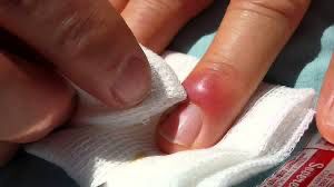 Tchad : Panaris, infection bactérienne ou pratique occulte ? Tchad : Panaris, infection bactérienne ou pratique occulte ?