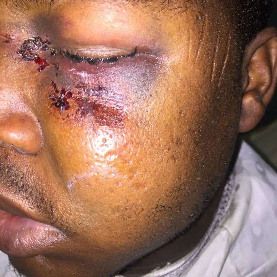 Le visage tuméfié du commandant du Commissariat de Sécurité Publique (CSP16), Ahmaday Banda après une agression par des collègues en service. Alwihda Info
