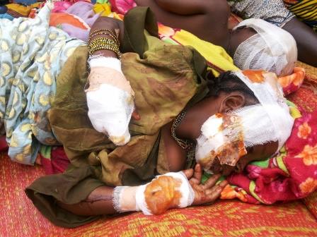Une petite fille musulmane écorchée par les milices Anti-Balaka à Bangui. © Diaspora Media