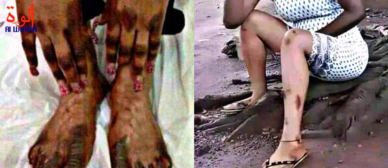 Dépigmentation au Tchad : elles veulent absolument devenir blanches Dépigmentation au Tchad : elles veulent absolument devenir blanches