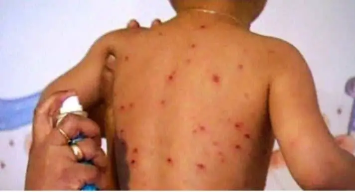 Tchad : l'importance de la vaccination pour protéger les enfants contre la rougeole