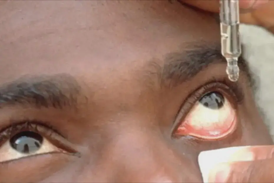 Cameroun : Epidémie de conjonctivite en cours