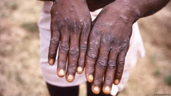 La variole du singe frappe le Cameroun : Cinq cas et deux décès