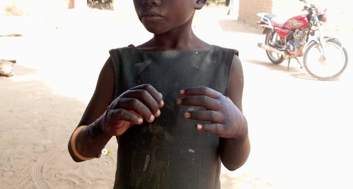 Tchad : une enfant brûlée par sa mère après une fausse accusation de vol