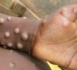 Tchad : on réclame la campagne d'éradication de la variole du singe, comme pour le Covid-19 