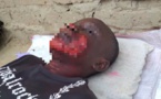 Tchad : il brûle le visage de son ami qui l'a dénoncé pour vol