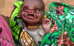 Tchad : naissance d’un enfant malformé à Lamé, un appel à l'aide lancé