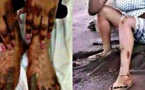 Dépigmentation au Tchad : elles veulent absolument devenir blanches