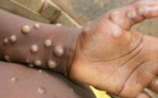 Tchad : on réclame la campagne d'éradication de la variole du singe, comme pour le Covid-19 