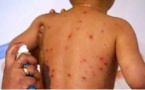 Tchad : l'importance de la vaccination pour protéger les enfants contre la rougeole