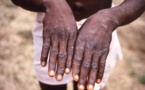 RDC : avec l’apparition de l’épidémie mortelle de Mpox, les enfants sont en danger