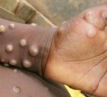 Tchad : on réclame la campagne d'éradication de la variole du singe, comme pour le Covid-19 